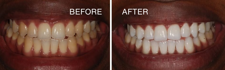 Enamel Restore+| Nano-Hydroxyapatite toothpaste 16 BEFORE